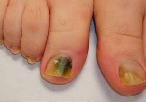 L'infection affecte les plaques de ongles