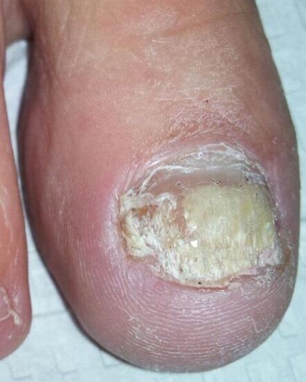 Le champignon dans les jambes