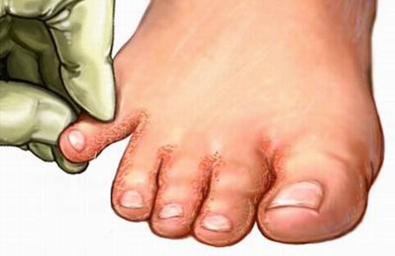Le champignon dans les jambes