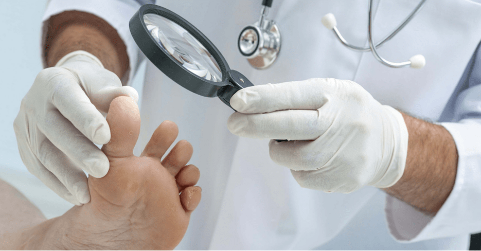 Les premiers symptômes du champignon des jambes