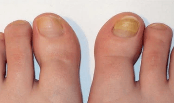 L'étape initiale du champignon des ongles