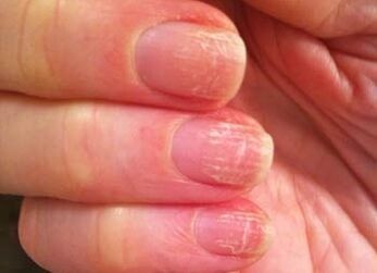 La phase initiale des champignons sur les ongles