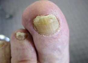 Les causes de l'apparence de champignon sur les ongles