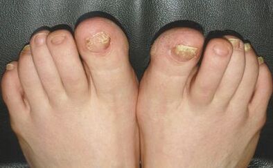 Signes de champignons sur les ongles