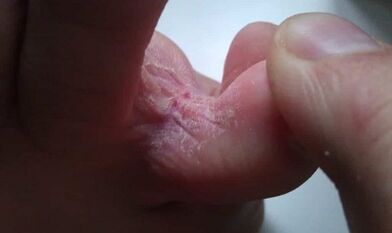 Étapes du développement des champignons entre les doigts des pieds