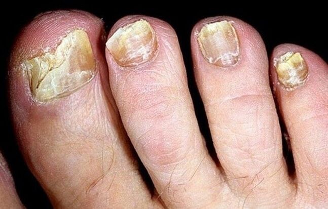 champignon des ongles