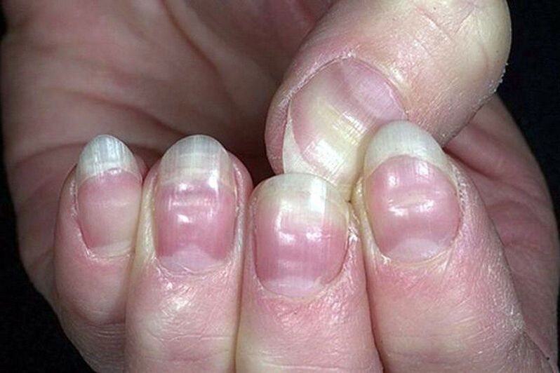 leuconychie sur les ongles